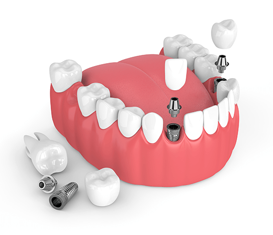 Dental Implants Riverhead NY